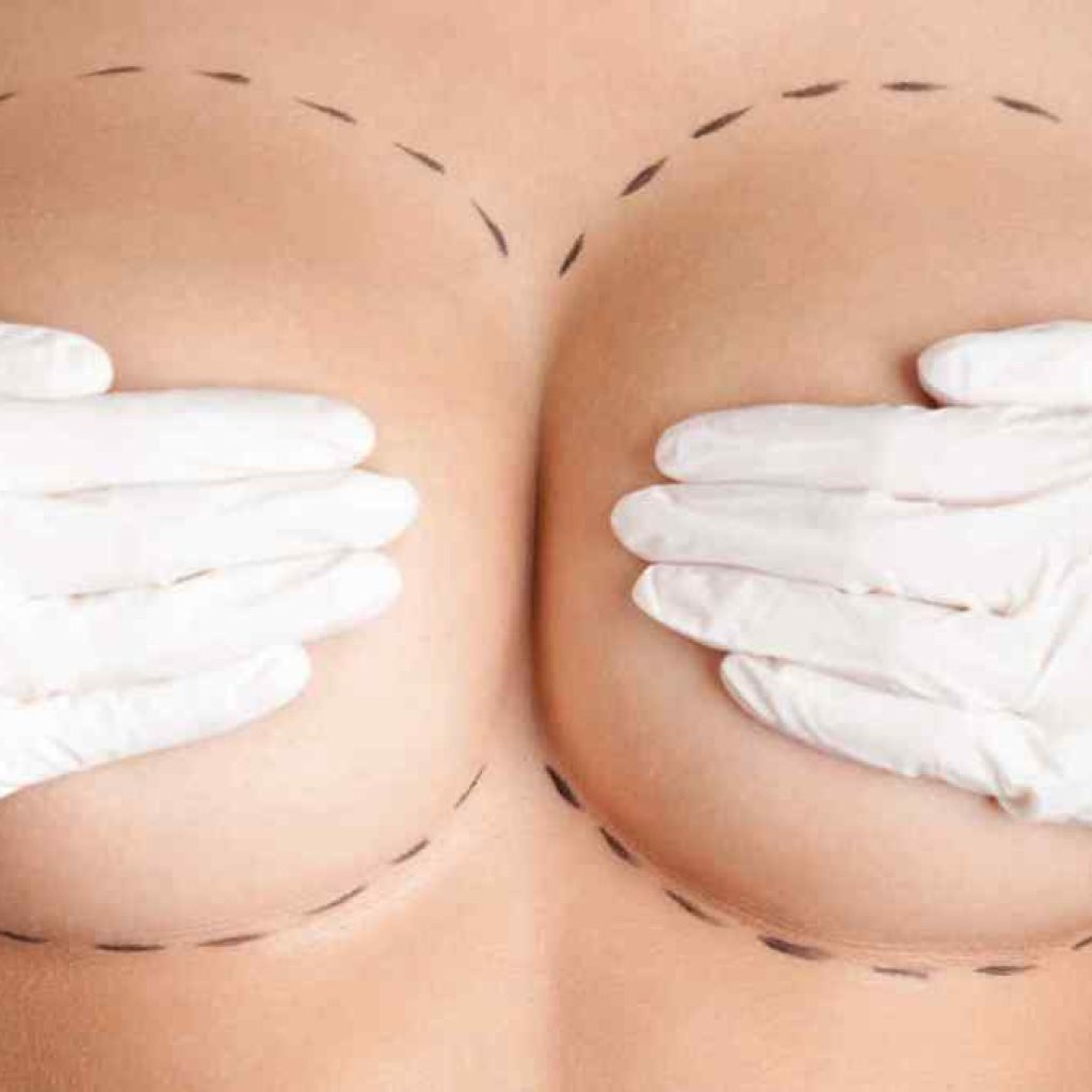 operación de aumento de mamas