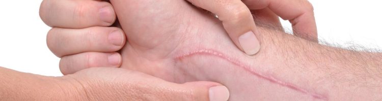 Cómo prevenir y tratar las cicatrices: una guía completa